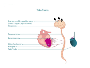 Cardiomyopathie tako-tsubo hotsell