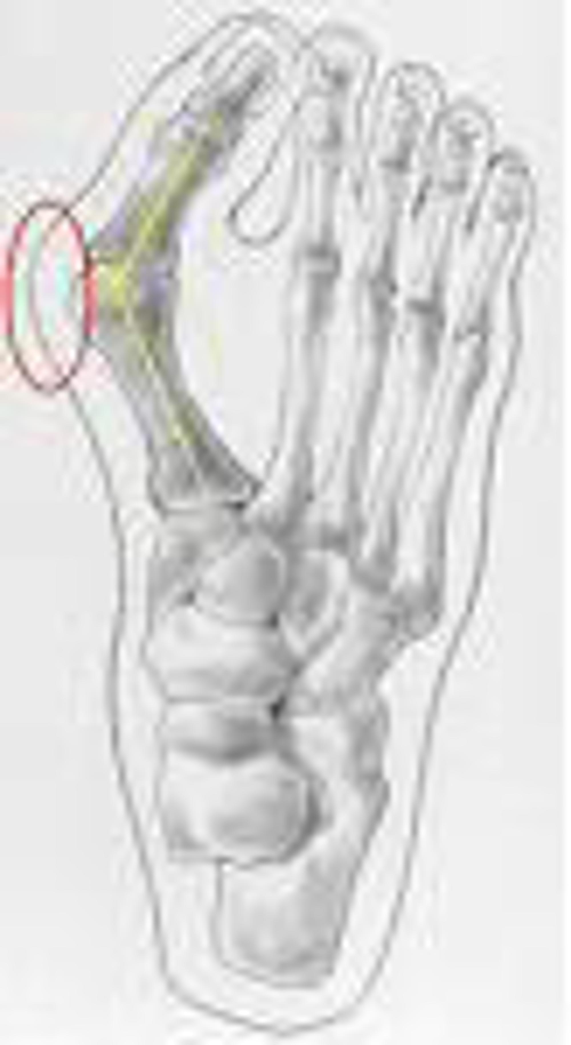 Hallux Valgus