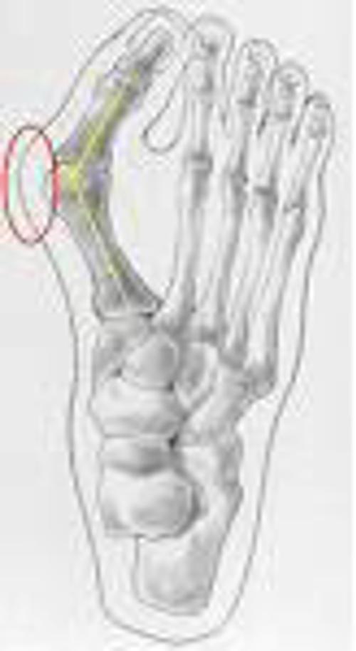 Hallux Valgus