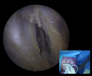 3C. Zicht op de zenuwen van vanuit de nek naar de arm gaan (plexus brachalialis)